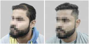 wrong hair transplant