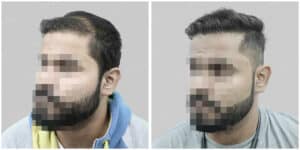 wrong hair transplant