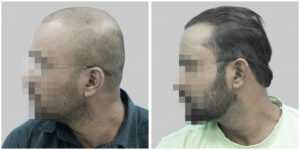 wrong hair transplant