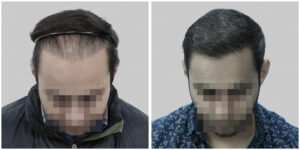 corrective hair transplant