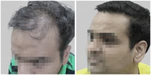 wrong hair transplant
