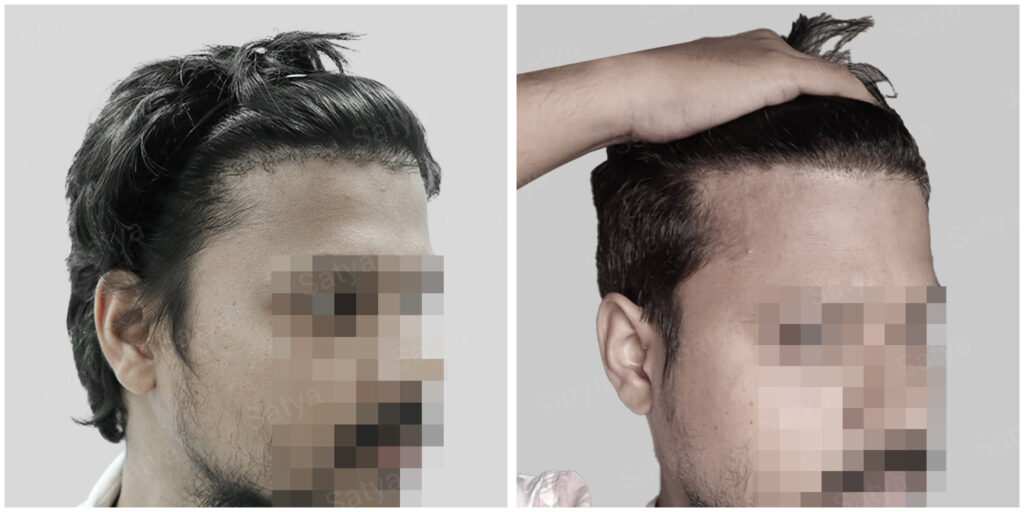 repair hair transplant