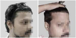 repair hair transplant
