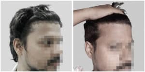 repair hair transplant