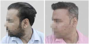 wrong hair transplant