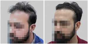corrective hair transplant