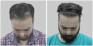 repair hair transplant