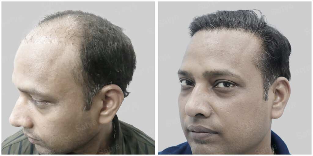 repair hair transplant
