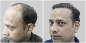 repair hair transplant