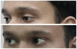 eyebrow hair transplant