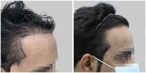 repair hair transplant result