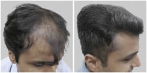 fue hair transplant
