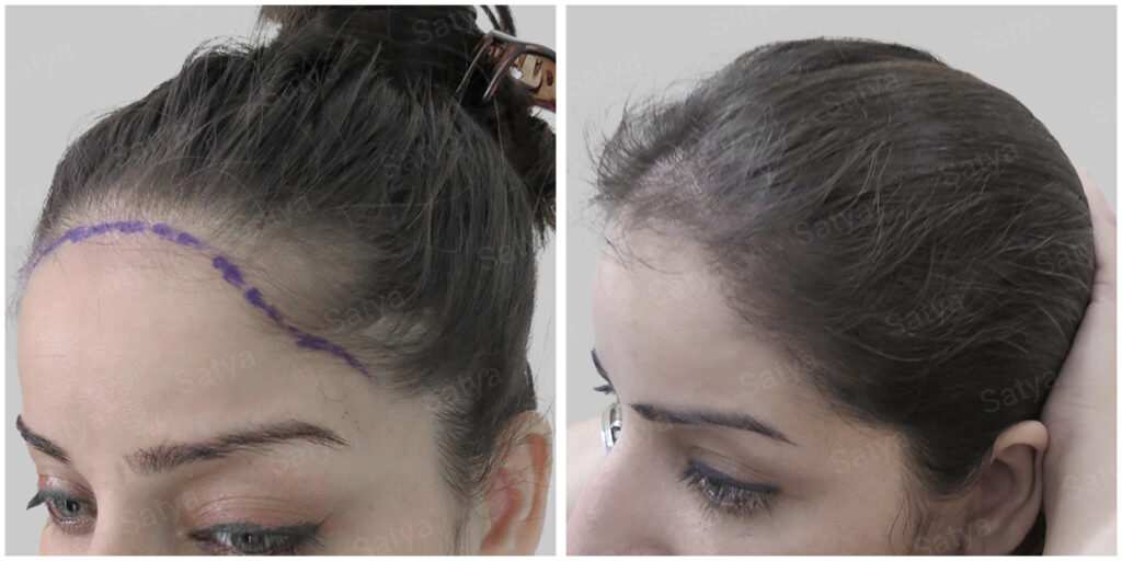 female hair transplant