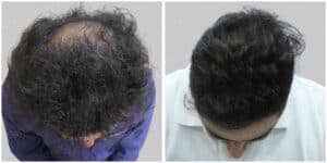 fue hair transplant
