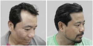 hair regrowth