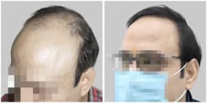 hair transplant