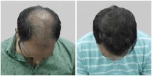 synthetic hair transplant