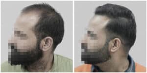 synthetic hair implant