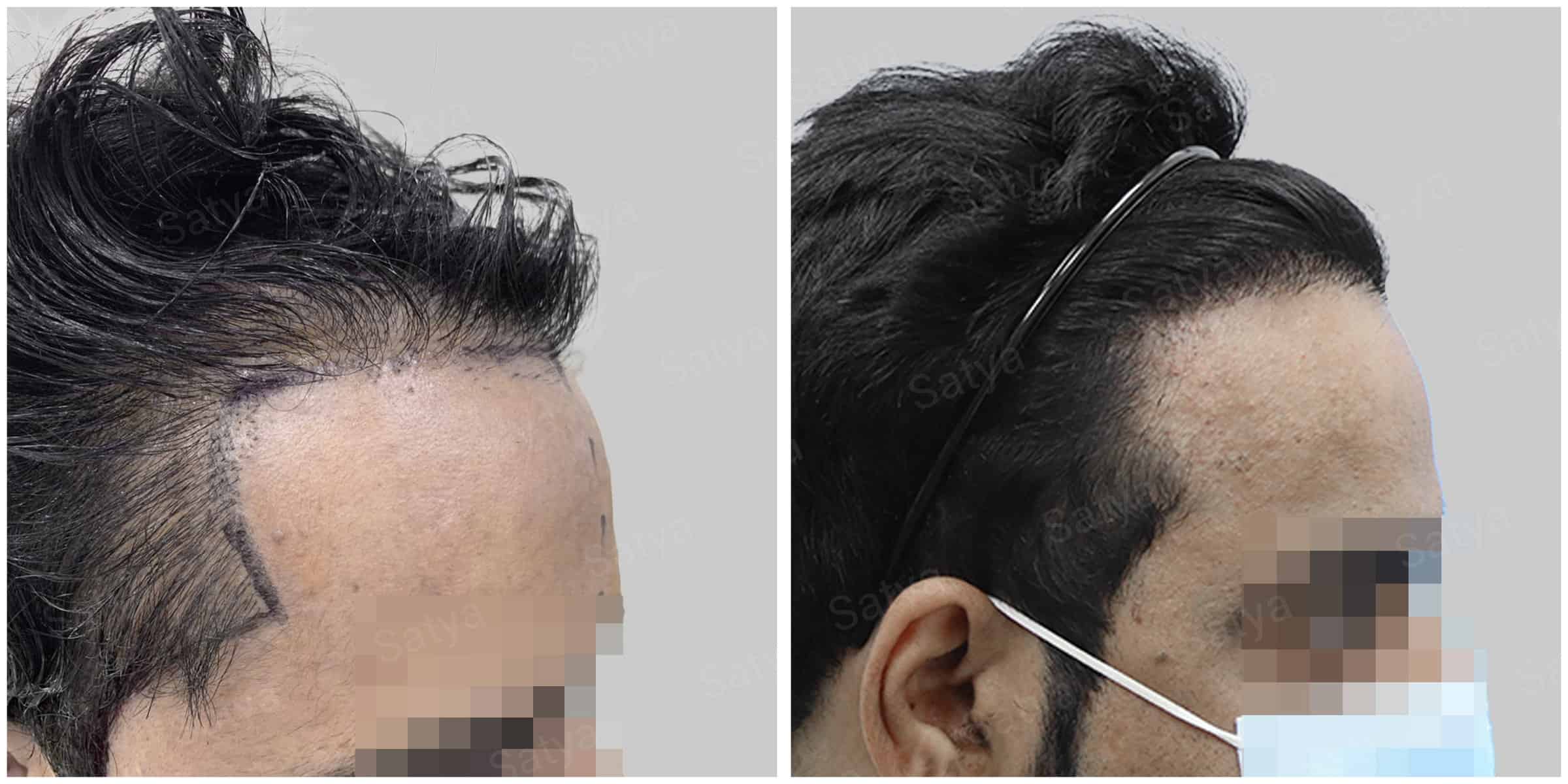 repair hair transplant result
