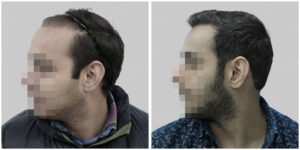 corrective hair transplant