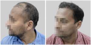 repair hair transplant