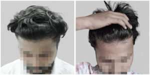 repair hair transplant
