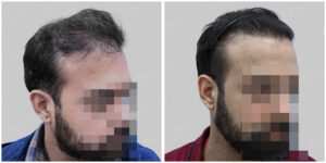 corrective hair transplant