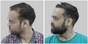 repair hair transplant
