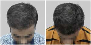 wrong hair transplant