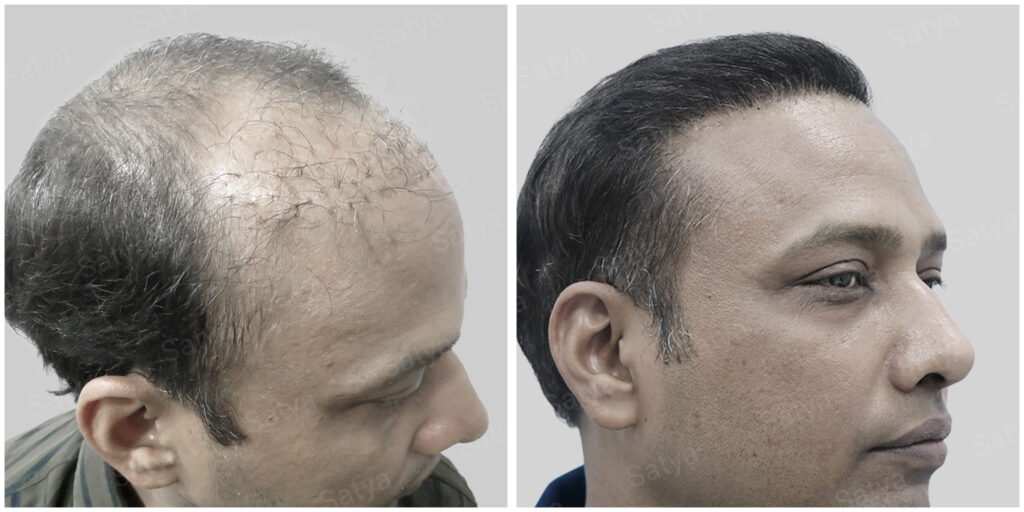 repair hair transplant