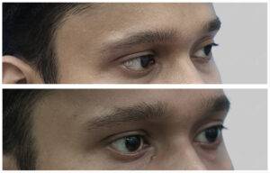 eyebrow hair transplant