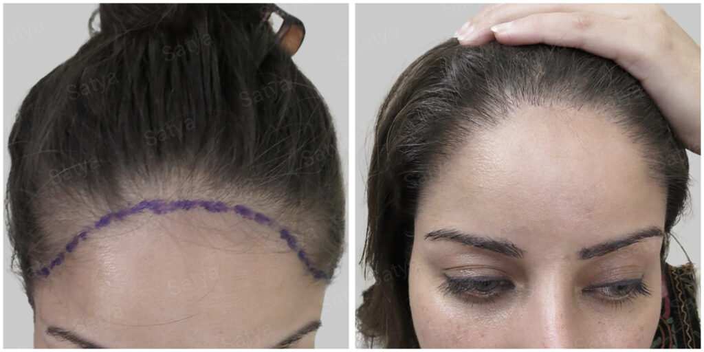 female hair transplant