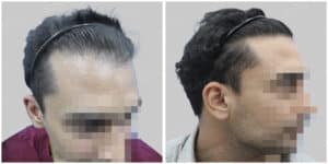 repair hair transplant