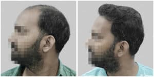 synthetic hair transplant