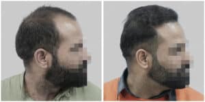 synthetic hair implant