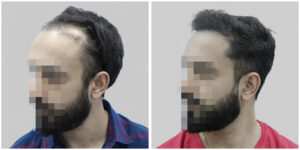 repair hair transplant result India