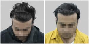 repair hair transplant