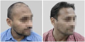 repair hair transplant