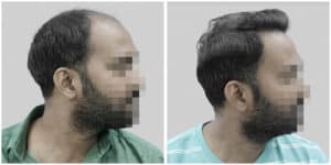 synthetic hair transplant