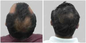 repair hair transplant