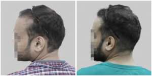 repair hair transplant