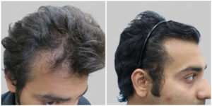 wrong hair transplant