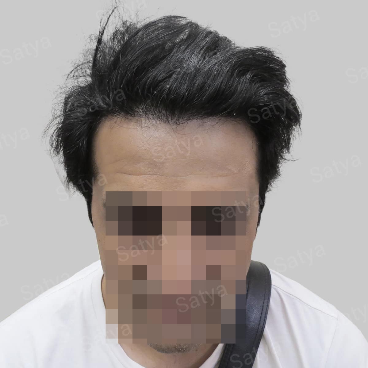 wrong hair line repair