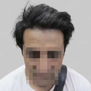 wrong hair line repair