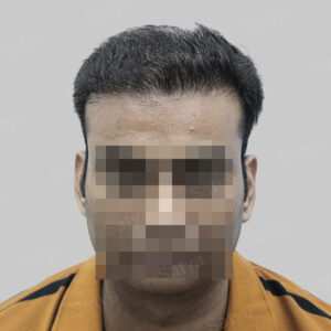 corrective hair transplant
