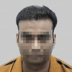 wrong hair transplant