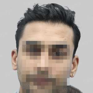 repair hair transplant