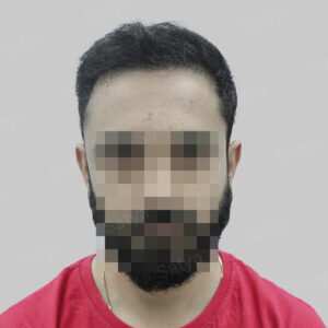 repair hair transplant result