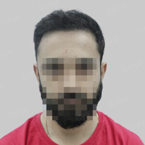 repair hair transplant result in India