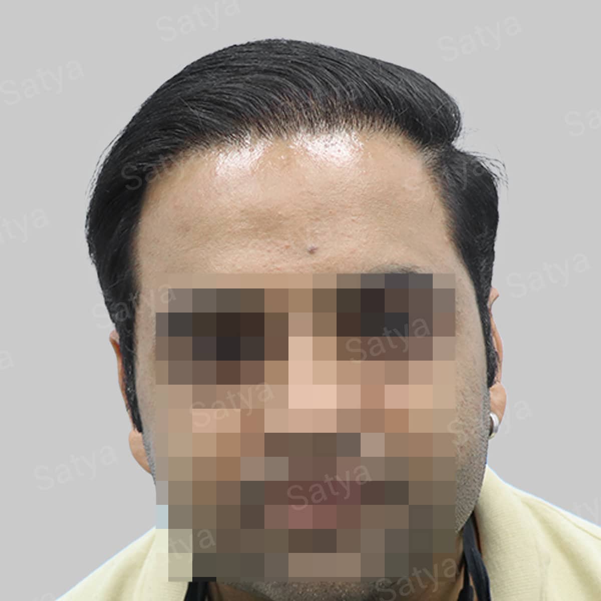 wrong hair transplant result